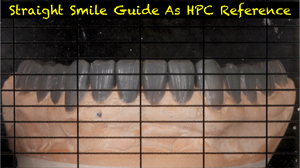 Straight Smile Guide (2 Included for dentist and laboratory)