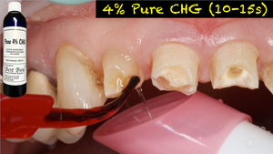 Case of Pure 4% CHG Bottles (12-236ml/8oz) 200 3cc Applicators and 40 Inspiral Brush Tips Included! Included!
