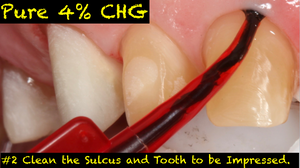 Case of Pure 4% CHG Bottles (12-236ml/8oz) 200 3cc Applicators and 40 Inspiral Brush Tips Included! Included!